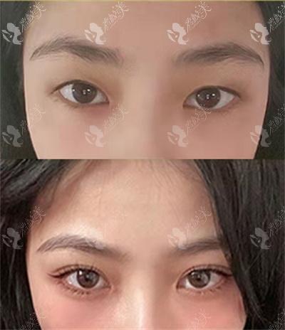 南宁右眼降至视力姐姐割双眼皮(门诊部右眼南宁华美视力)