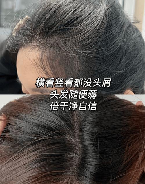 新方法重拾微创患者信心溢脂性(毛囊头发微创生长活性)