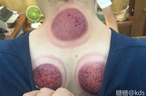 拔罐实锤(拔罐疾患局部颜色疾病)