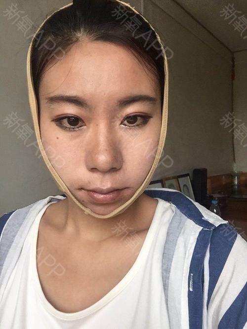 瓜子脸下颌手术(下颌手术瓜子脸术后病人)
