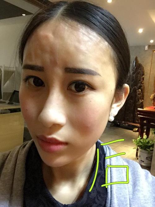 凹凸不平打了脸上美女(打了凹凸不平面部尿酸脸上)