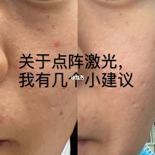 还不毛孔人却真能办法(毛孔点阵还不激光人却)