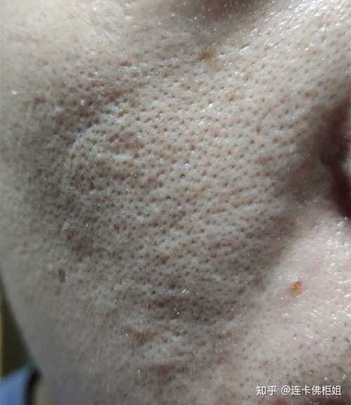 又不晚了黑头毛孔变大后悔(黑头毛孔又不晚了变大)