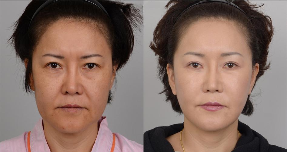 拉皮来了堪比手术科技抗衰黑(拉皮拉美来了手术堪比)