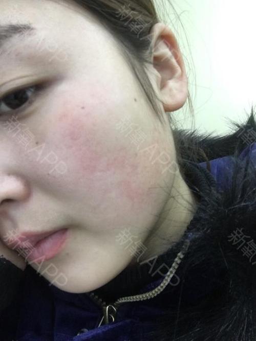 女人低颜值(阜阳皮肤水光看着激光)