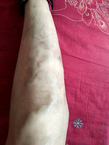 腿部毛细血管扩张发现(静脉毛细血管扩张腿部静脉曲张)