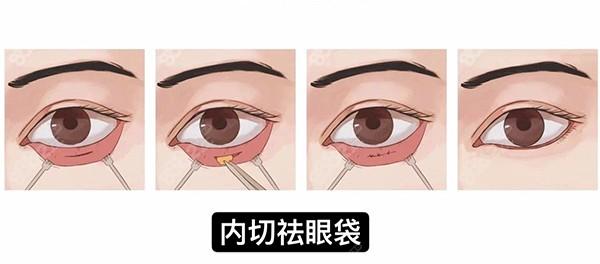 眼袋北京手术整形手术方法八大处(眼袋皮肤脂肪松弛手术)