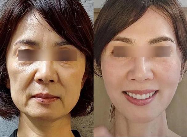几个后遗症人做性价比担心适合(面部拉皮几个性价比后遗症)