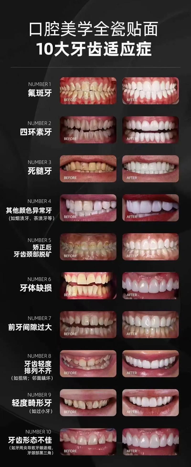 你敢基础美牙师(机构你敢贴面基础牙齿)