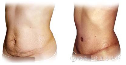 腹壁整形术TummyTuckAbdominoplasty(腹壁整形术整形外科产后术后)