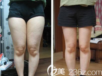 大法大美人冬季天越冷人越美(激光冬季脂肪吸脂都是)