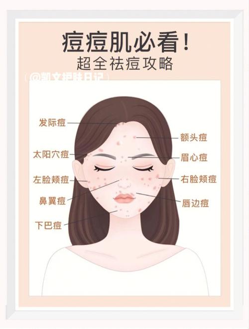这份粉刺最有效祛痘攻略方法(粉刺祛痘这份攻略提取物)