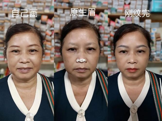 二十多位慎重老人纹眉(乐清中老年人中老年负责人手术)