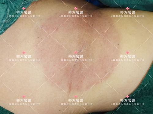 要注意结束美容整形医学美容项目学生(腋臭湖北日报手术武汉市腋下)