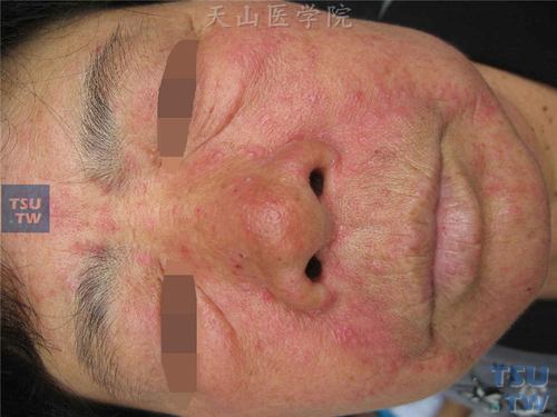 要用激素患者性皮炎专家(激素性皮炎患者要用医生)