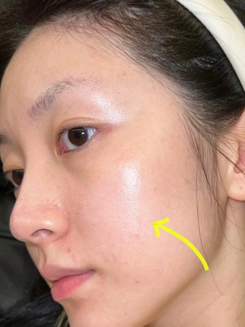 该如何痘印(激光痘印该如何渝北皮肤)