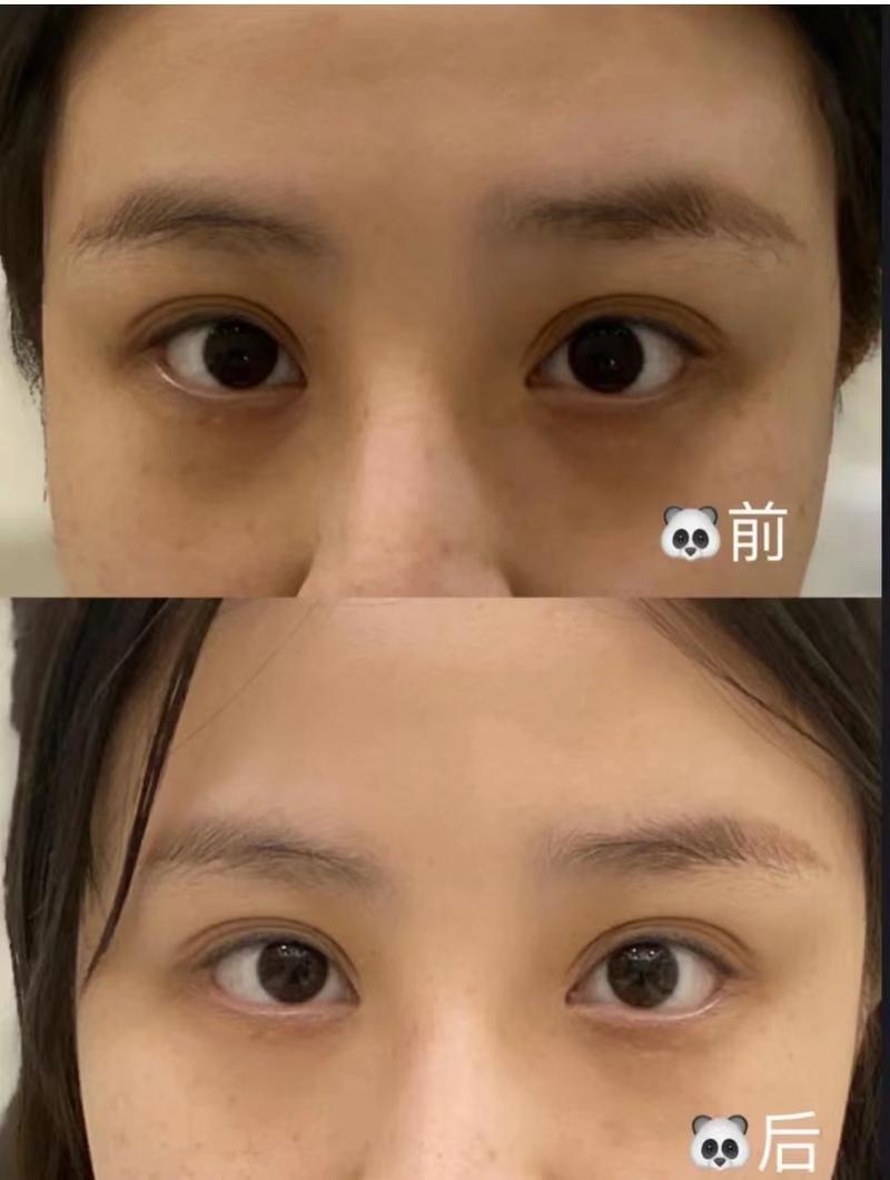走弯路名堂眼部美得美少(胶原皮肤黑眼圈衰老骨质)