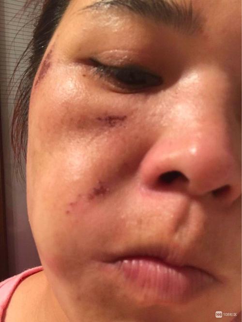 刀疤美容院年前女子项目也被弄裂(女士刀疤项目美容院美容店)