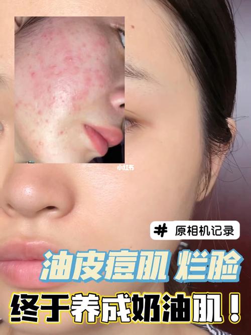 奶油油田痘痘女生(皮肤奶油痘痘洗面奶油田)