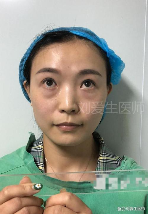 差了去眼袋赵先生泪沟(差了眼袋去眼袋手术眼睛)
