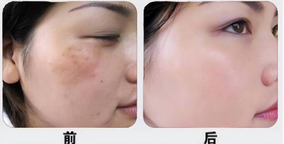 美白万种方法(黑色素美白皮肤刺激性果酸)