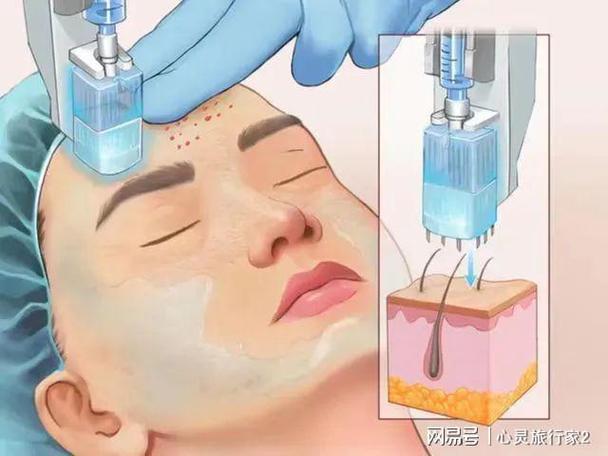 尿酸茅台类产品女人肉毒素(尿酸产品水光肉毒素面部)