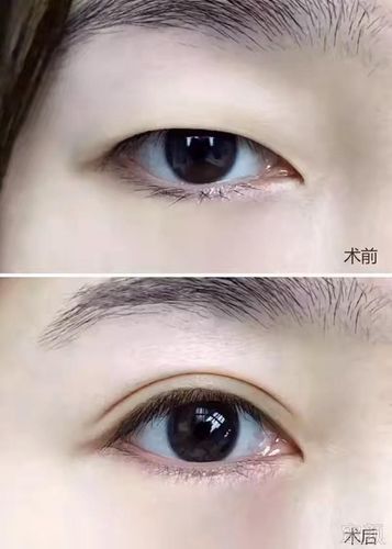 眼部完美功能(眼部山东功能双眼皮完美)