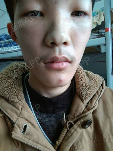 眼袋术后男士当天在上海消失了(眼袋术后手术当天男士)