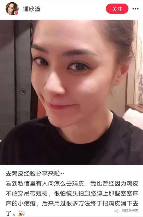 阿娇祛痘去黑头(阿娇去黑头毛孔祛痘黑头)