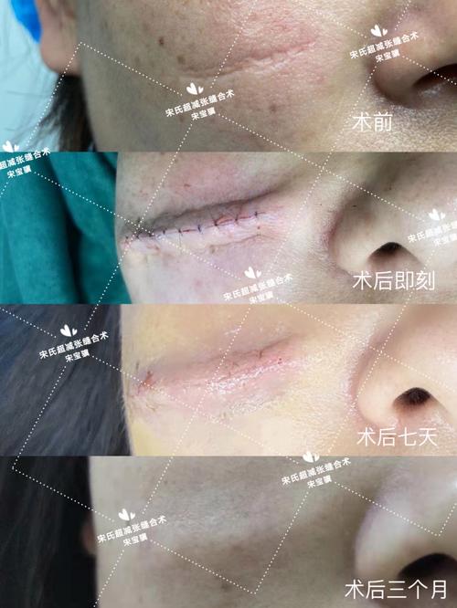 面庞巧用孩子美丽技术超减张(小明手术河南省面庞孩子)