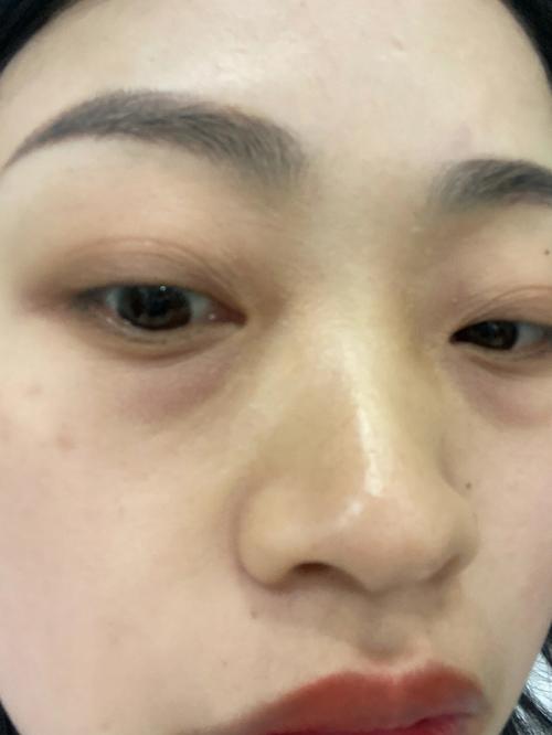 锦囊眼部眼睛(黑眼圈眼部眼睛锦囊皮肤)