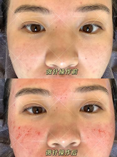 美容术毛孔神奇平痘坑微针(毛孔美容术效果皮肤神奇)