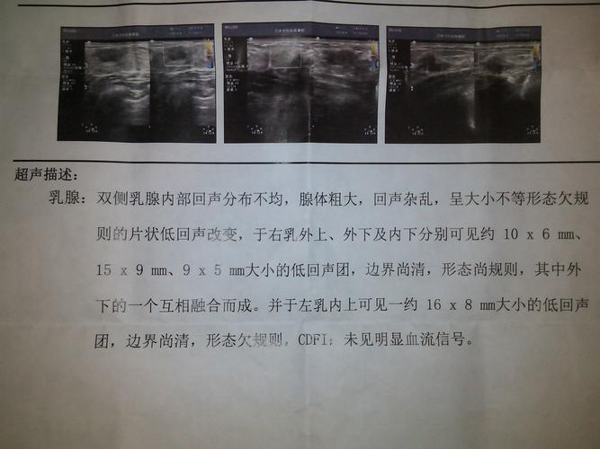 乳腺读懂七步报告彩超(乳腺回声病灶乳房超声)