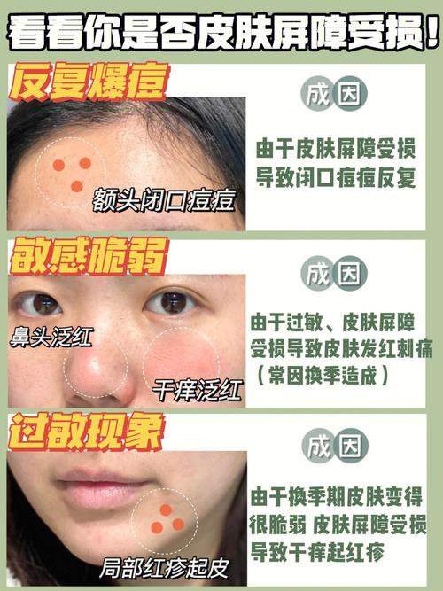 屏障步骤敏感皮肤指南(皮肤屏障敏感砖墙肌肤)