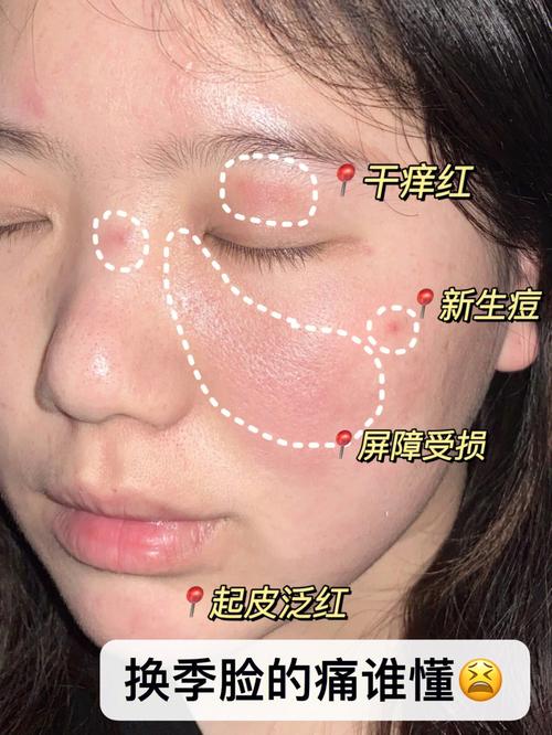 面部泛红几件事建议女人(泛红皮肤面部建议几件事)