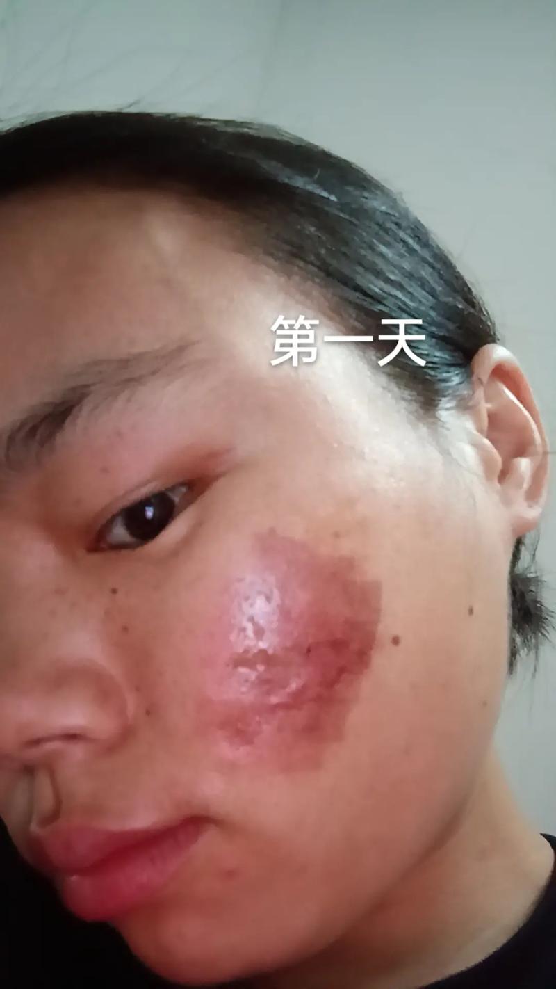 瘢痕两种点阵痤疮疗效激光治疗(瘢痕点阵痤疮激光治疗激光)