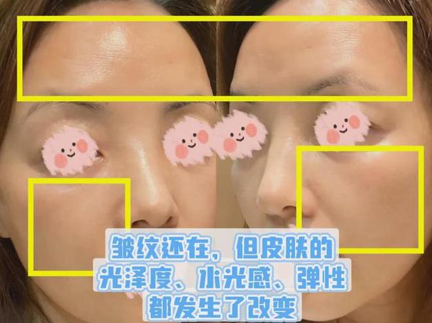 不做支架面部为何物为妙新鲜(拉皮面部支架新鲜不做)