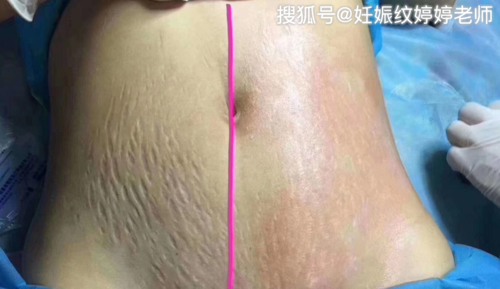 美丽妊娠纹(妊娠纹胎儿准妈妈美丽腹部)
