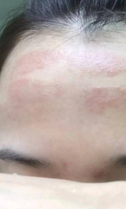 方式喜欢皮肤科医生(皮肤嫩肤光子痤疮深圳市)