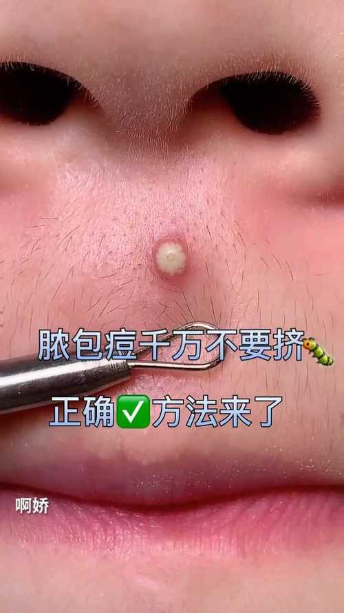 痤疮毛钱痘痘彻底清除经验者实操(痘痘痤疮毛钱彻底清除经验)