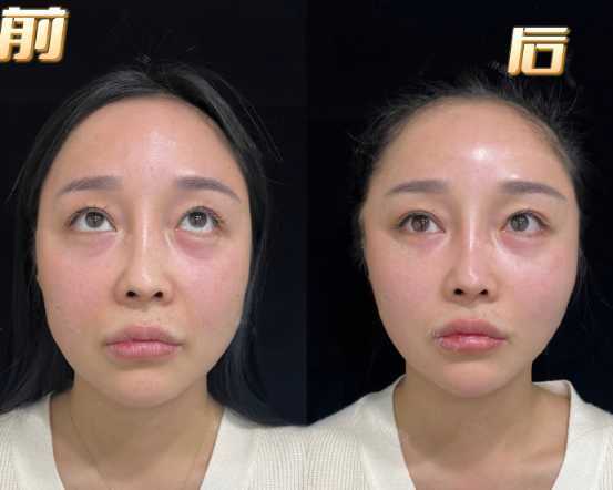 不能少医生经验项目(项目拉皮不能少眼袋面部)