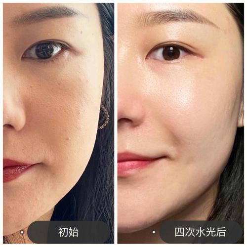 节前必看质感几招细腻皮肤(毛孔粗大皮肤点阵水光)