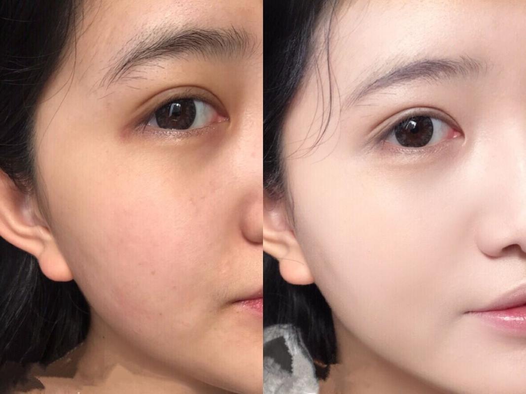 效果(效果水光下巴组合面部)