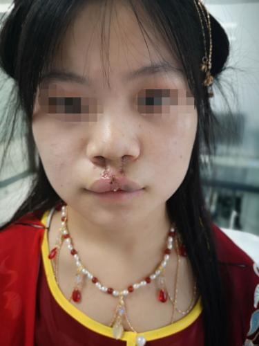 唇腭裂矫正术(术后唇腭裂手术伤口腭裂)