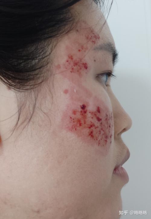 最想爱美激光真相注意了(激光皮肤局部或者是恢复期)
