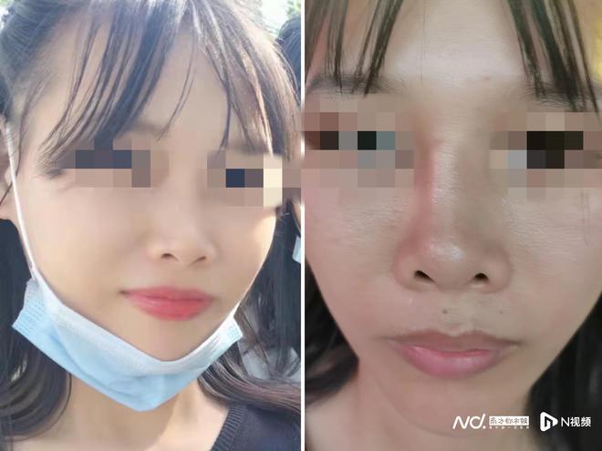 万元诊所歪了鼻子医疗美容女子(诊所鼻子女士万元医疗美容)