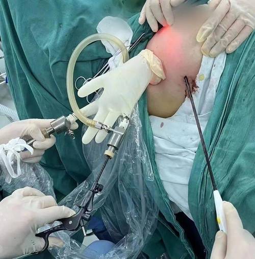 腋窝乳腺癌身心二院患者进展(腋窝乳腺癌乳腺患者腺体)