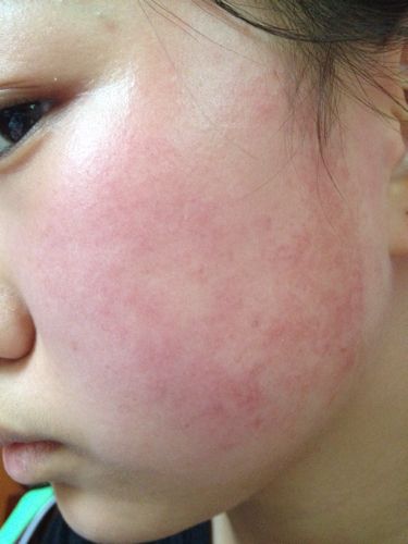 脸部泛红敏感(皮肤屏障敏感顺义儿童医院)