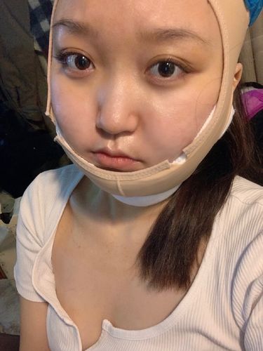 只需下颌做一个奶奶吸脂少女(下颌吸脂双下巴只需面部)