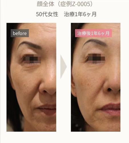 水光干细胞日本松弛毛孔皱纹(水光日本干细胞医疗皮肤)